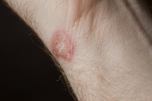 Fungal Skin Infections: Unraveling the Basics of Ringworm