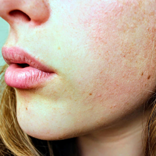 Close-up of woman being treated for rosacea.