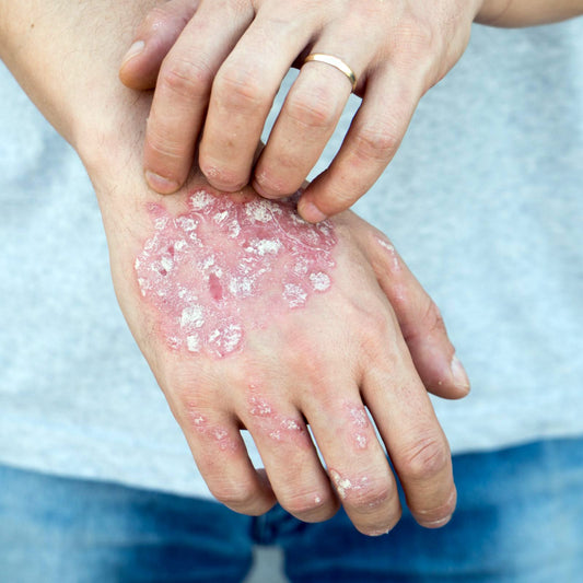 Psoriasis on the hands.
